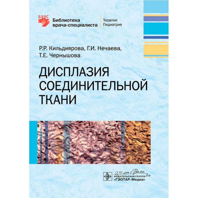 Дисплазия соединительной ткани