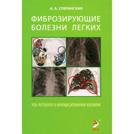 Органы дыхания. Туберкулез. Астма, книга Фиброзирующие болезни легких. Роль рентгенолога в мультидисциплинарном консилиуме купить по скидке